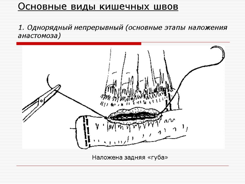 Основные виды кишечных швов  1. Однорядный непрерывный (основные этапы наложения анастомоза) Наложена задняя